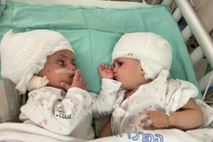 2 bé song sinh được phẫu thuật thành công. (Nguồn: The Jerusalem Post)
