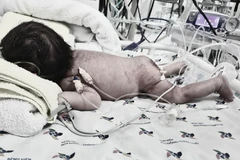 Bệnh nhi sau khi được "giải thoát" khối u quái khổng lồ vùng cùng cụt. (Ảnh: TTXVN phát)