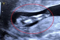 Bệnh viện Phụ sản thành phố Cần Thơ phát hiện một trường hợp thai nhi mắc hội chứng người cá. (Ảnh: TTXVN)