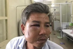 Khởi tố đối tượng đánh nhân viên Trung tâm công viên cây xanh ở Huế