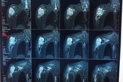 Bệnh nhân hiện tại sức khỏe đã ổn định. (Ảnh: Bệnh viện cung cấp)