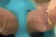 Nữ bệnh nhân bị bỏng phức tạp vùng da đùi sau hút mỡ. 