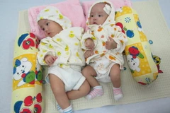 Phẫu thuật thành công cặp song sinh dính liền phần ngực