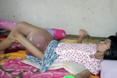 Cảm thương người phụ nữ có khối u nặng gần 10kg ở đùi