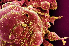 Hình ảnh quét qua kính hiển vi điện tử cho thấy một tế bào (màu đỏ) bị virus SARS-COV-2 (màu vàng) xâm nhập, lấy từ mẫu bệnh phẩm của bệnh nhân COVID-19. (Ảnh: AFP/ TTXVN)