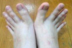 Người phụ nữ có ngón chân dài như ngón tay. (Nguồn: dailymail.co.uk)