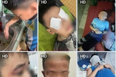 Nhiều trường hợp học sinh bị rát da mặt và mắt nên phải đắp khăn mặt ướt. (Nguồn: Phụ huynh cung cấp)