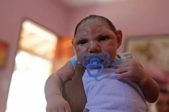 Một trẻ sơ sinh bị mắc căn bệnh đầu nhỏ do mẹ bị nhiễm virus Zika khi mang thai. (Nguồn: THX/TTXVN)