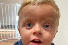 Bailey với nước da nhem nhuốc vì thuốc nhuộm. (Nguồn: Metro)