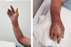 Hình ảnh tổn thương viêm mô bào của bệnh nhân. (Ảnh do bệnh viện cung cấp)