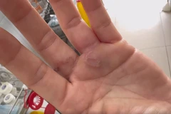 Hình ảnh bàn tay có giun làm ổ dưới da do nhiễm giun chó mèo. (Ảnh: Bệnh viện cung cấp)