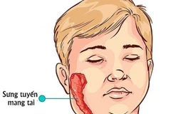 [Video] Giới y tế cảnh báo nguy cơ bệnh quai bị quay trở lại