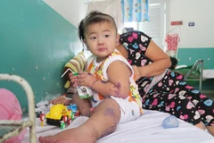 Một bệnh nhi mắc tay chân miệng được điều trị tại Bệnh viện Nhi đồng 2. (Ảnh: Đinh Hằng/TTXVN)