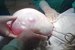 Khối u được lấy ra khỏi người bệnh nhân. (Ảnh: baolaocai)