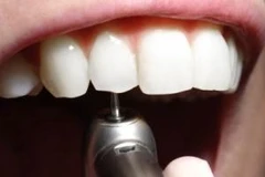 Với tiện ích mới, bệnh nhân sẽ không còn phải nghe tiếng máy khoan "ghê sợ" của nha sĩ. (Ảnh: Internet)