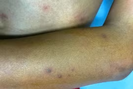 Các vết đốt trên khắp cơ thể. (Ảnh: Bệnh viện Sản-Nhi Cà Mau)
