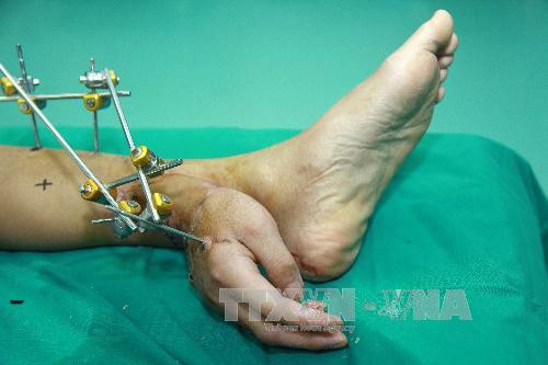 Kỳ lạ chàng trai có bàn tay mọc gần...bàn chân ảnh 2