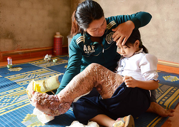 Hành trình đứng lên phi thường của cô bé “chân voi” ở Tây Nguyên ảnh 1