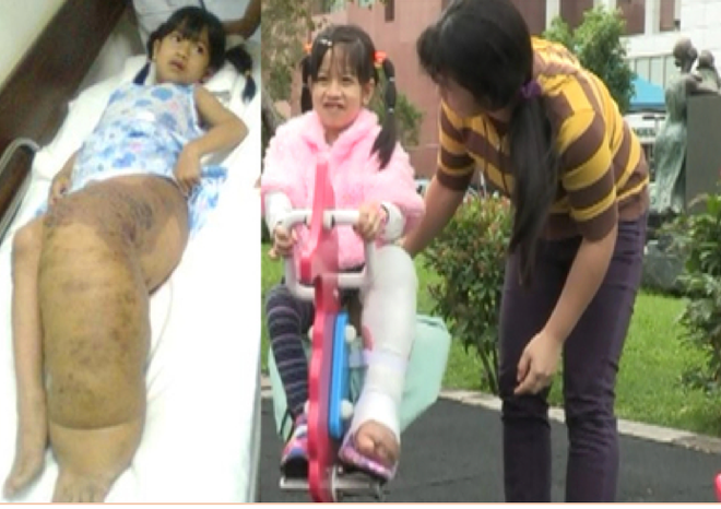 Hành trình đứng lên phi thường của cô bé “chân voi” ở Tây Nguyên ảnh 2