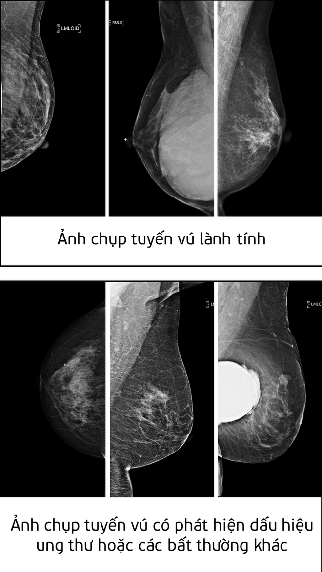 Ảnh chụp tuyến vú lành tính và ảnh chụp tuyến vú có phát hiện dấu hiệu ung thư hoặc các bất thường khác. Chuyên gia AI Việt Nam giành Giải Nhất giải pháp phát hiện ung thư ảnh 2