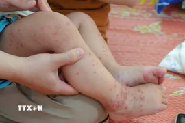 Các nốt bọng trên chân trẻ mắc tay chân miệng. (Ảnh: TTXVN phát)