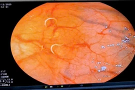 Ổ giun tóc trong đại tràng của bệnh nhân. (Nguồn: Bệnh viện Bệnh Nhiệt đới Trung ương)