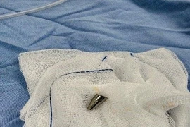 Dị vật là đầu ngòi bút, bề dày thành khoảng 1,8mm, chiều dài khoảng 18mm. (Nguồn: Bệnh viện Phụ sản-Nhi Đà Nẵng)