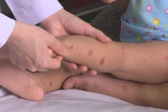 Trẻ nhiễm bệnh tay chân miệng tại thành phố Hồ Chí Minh. (Khánh Ly/Vietnam+)