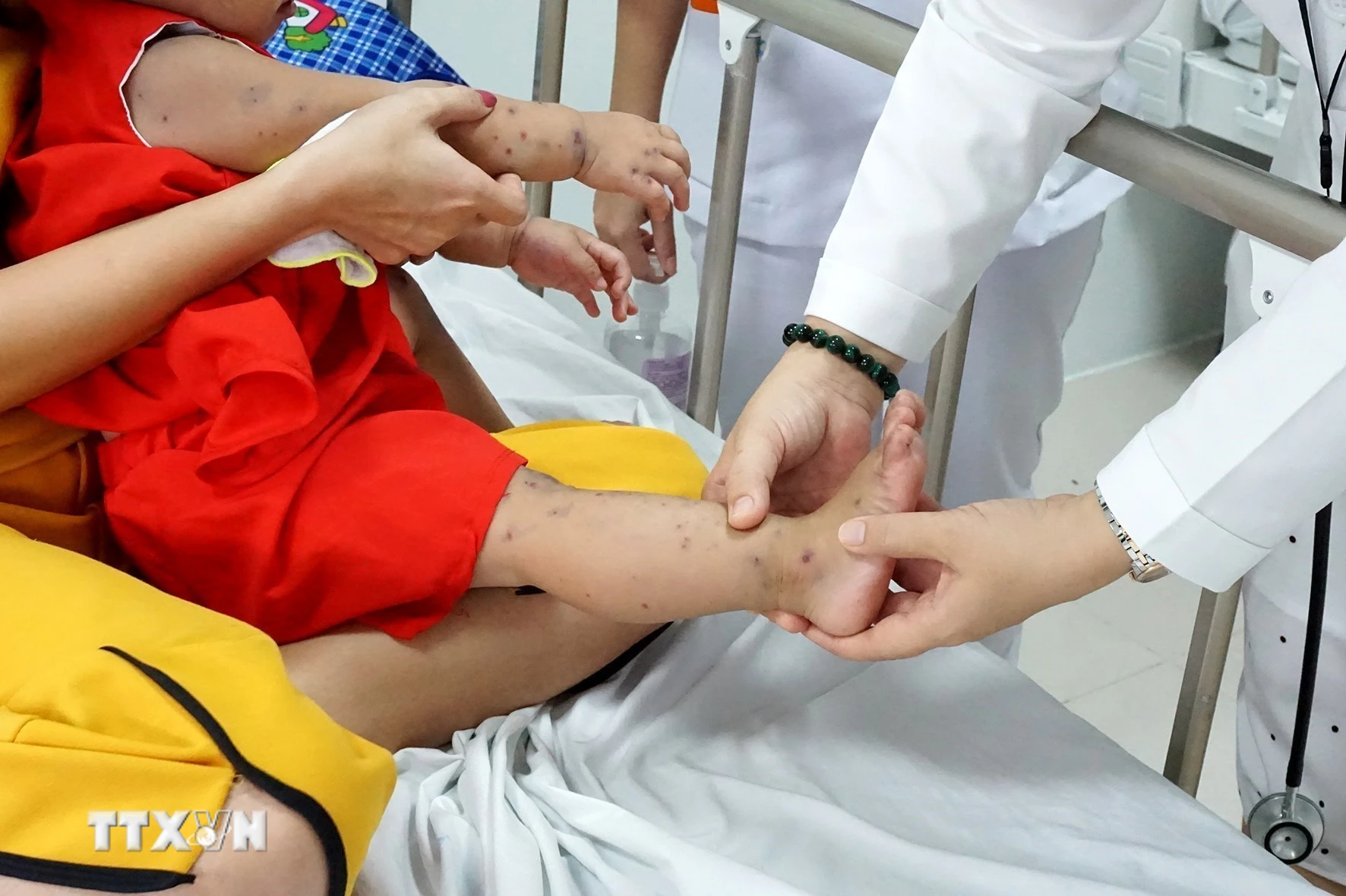 Bộ Y tế yêu cầu tăng cường thu dung, điều trị khi ca bệnh tay chân miệng tăng mạnh