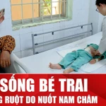 Bệnh viện Nhi đồng Đồng Nai cứu thành công ca thủng ruột do nuốt nam châm