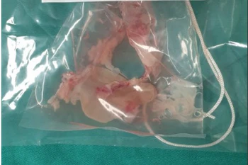 Ổ sán não khổng lồ được các bác sỹ lấy ra từ đầu của bệnh nhân. (Ảnh: PV/Vietnam+)