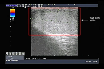 Hình ảnh siêu âm khối u. (Nguồn: Vietnam+)