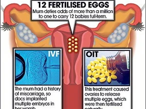 Hình vẽ tử cung của người mẹ với 12 trứng đã được thụ thai. (Ảnh: TT&VH)