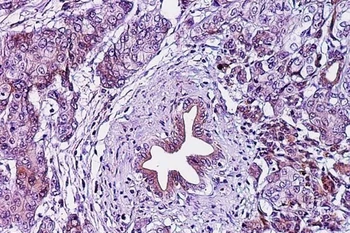 Lớp cắt biểu bì ung thư tuyến tụy. (Nguồn: eurekalert.org)