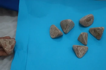 Bảy viên sỏi khồng lồ được lấy ra từ bụng bệnh nhân Mai. (Ảnh: Đậu Tất Thành/Vietnam+)