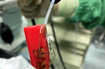 Chiếc bật lửa gas được gắp ra khỏi dạ day bệnh nhân T. (Ảnh: TTXVN phát)