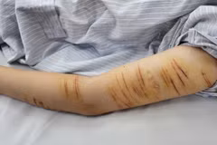 Một bệnh nhân là thanh thiếu niên tự rạch những vết trên cánh tay của mình. (Ảnh: BVCC)