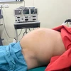 Khi bệnh nhân nhập viện, khối u đã phát triển rất to, tương đương thai 9 tháng. (Ảnh: PV/Vietnam+)