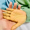 Bàn tay của bệnh nhân khi bị hôn mê gan do suy gan cấp tính, viêm gan virus B. (Ảnh: PV/Vietnam+)