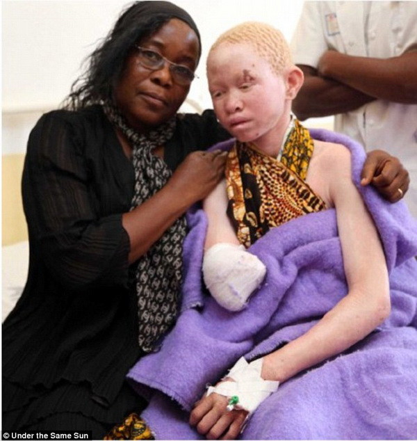 Người mắc bệnh bạch tạng ở Tanzania bị săn đuổi như thú vật ảnh 2