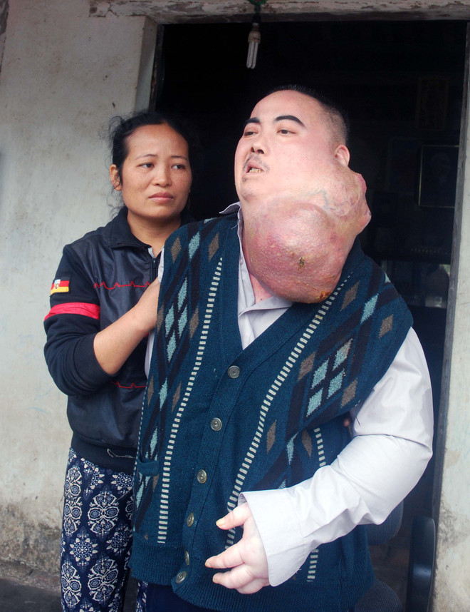 Hoàn cảnh khó khăn của người đàn ông có khối u khổng lồ trên mặt ảnh 2