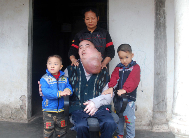 Hoàn cảnh khó khăn của người đàn ông có khối u khổng lồ trên mặt ảnh 1