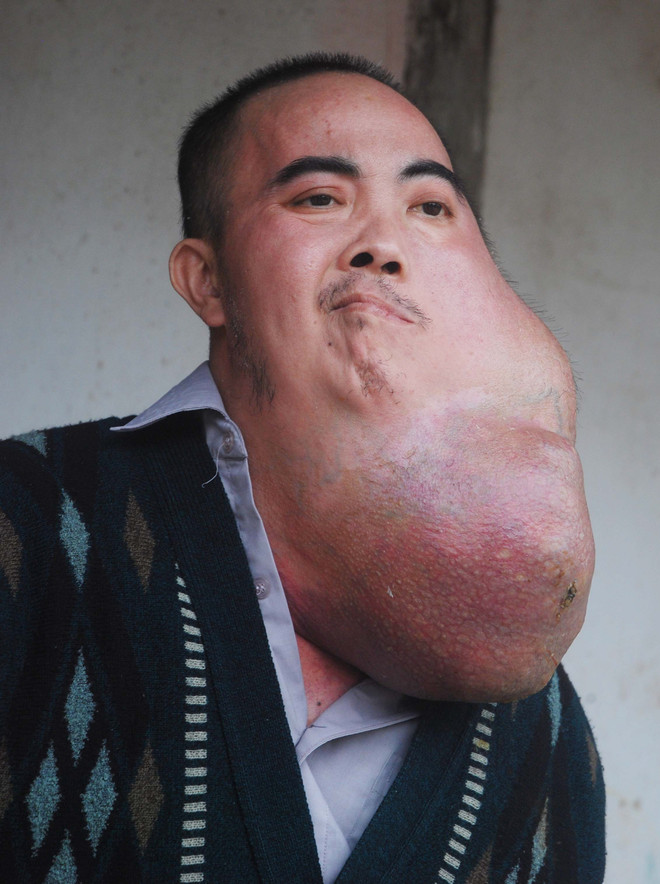 Hoàn cảnh khó khăn của người đàn ông có khối u khổng lồ trên mặt ảnh 3