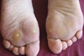 Vì sao chai chân lại gây đau nhức và cách xử lý, phòng ngừa hiệu quả