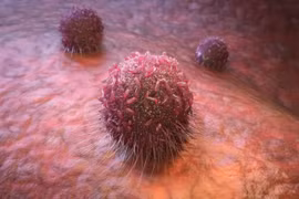 Tế bào ung thư. (Nguồn: scitechdaily)