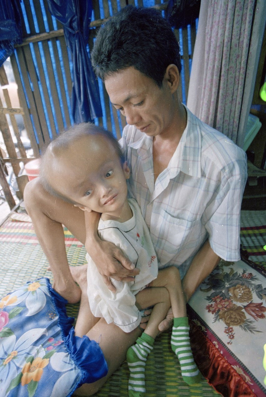 Anh Trần Quang Thân, ở chợ Đầm Nha Trang, chuyên làm nghề đào bới phế liệu, chủ yếu ở các khu quân sự Mỹ ngụy trước đây nên đã bị nhiễm chất độc da cam/dioxin. Hậu quả là con của anh bị dị dạng, không có trí nhớ (2000). (Ảnh: Ngô Mỹ/TTXVN)