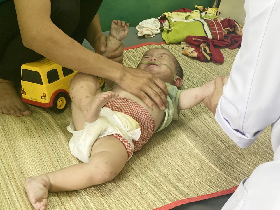  Một bệnh nhi mắc tay chân miệng điều trị tại Bệnh viện Nhi đồng 2, Thành phố Hồ Chí Minh. (Ảnh: Đinh Hằng/TTXVN)