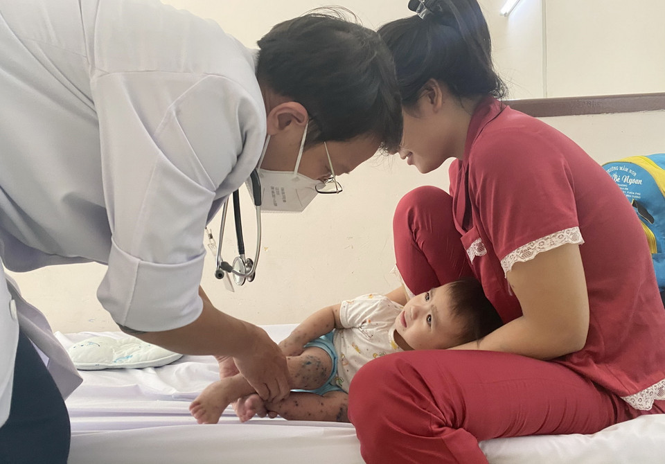  Một bệnh nhi mắc tay chân miệng điều trị tại Bệnh viện Nhi đồng 2, Thành phố Hồ Chí Minh. (Ảnh: Đinh Hằng/TTXVN)