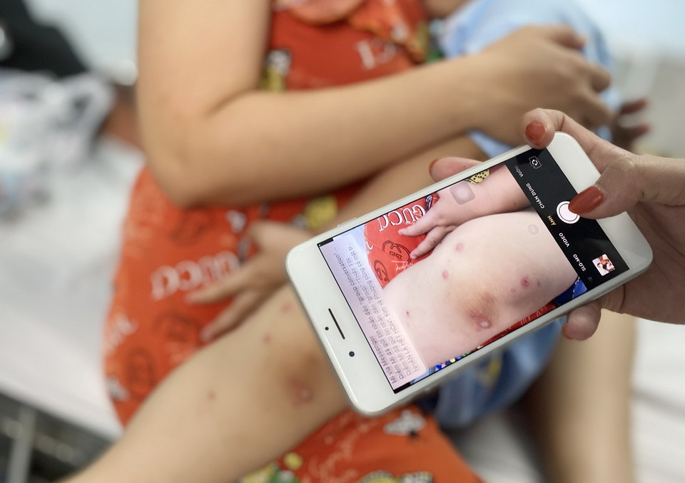  Nốt hồng ban ở chân của một trẻ mắc bệnh tay chân miệng. (Ảnh: Đinh Hằng/TTXVN)