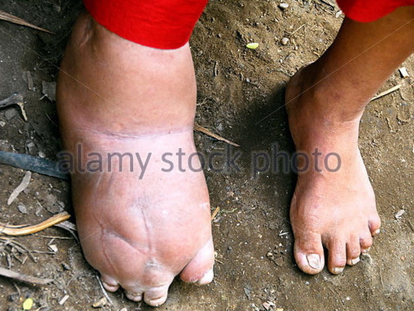 Campuchia được WHO công nhận đã xóa bỏ bệnh phù chân voi ảnh 1